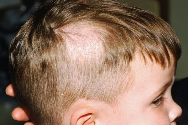 wypadanie włosów u dzieci