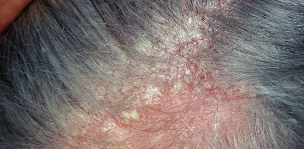 Łojotokowe zapalenie skóry głowy a choroby włosów